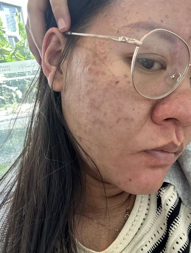 李女士怀孕期间样子及皮肤出现惊人变化。
